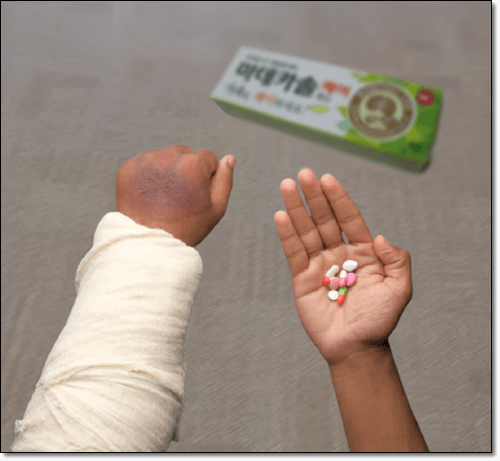 화상 환자 팔