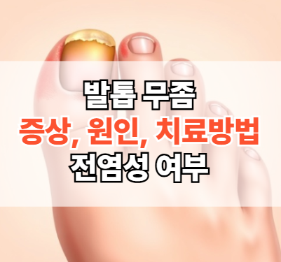엄지발톱무좀-증상-원인-치료방법