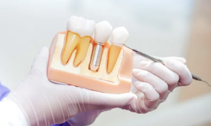 임플란트 모형 사진