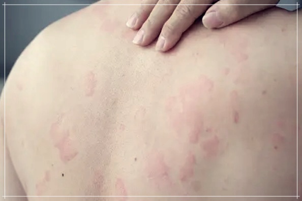 성인 열꽃 증상 즉시 없애는 방법 3가지