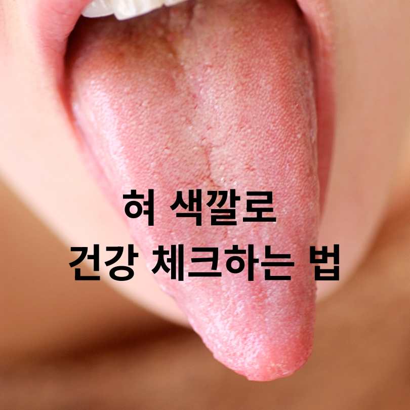 혀 건강 상태 체크법