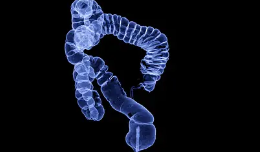 게실염 증상 치료 방법 게실염에 좋은 음식 원인 수술 종류 대장 게실염 재발 가능성