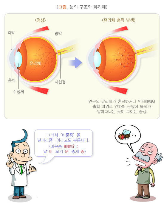 비문증