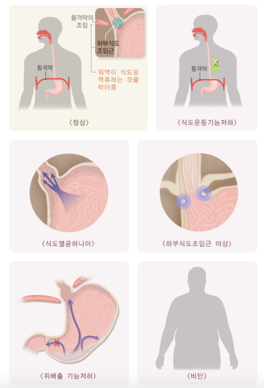 역류성식도염 발생원인