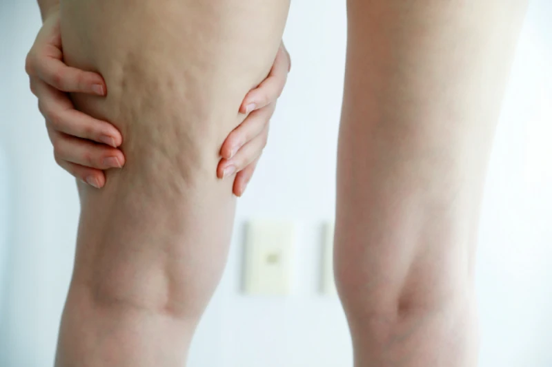 여성 허벅지 뒷 부분에 생기는 셀룰라이트