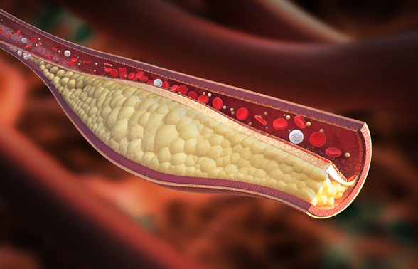 고지혈증 원인 증상 관리법 콜레스테롤관리 혈관건강 심혈관질환예방 건강검진 생활습관개선 운동효과 식이조절 중성지방 이상지질혈