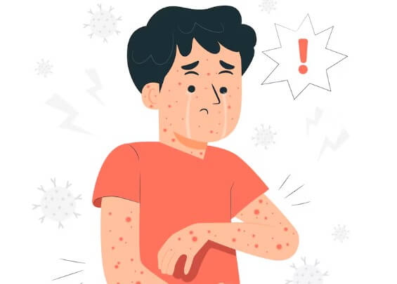 대상포진-전염-예방-수칙-전염성-2