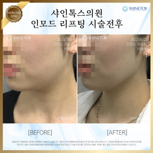 대전 인모드