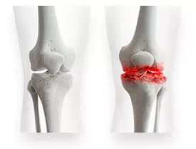 무릎-관절염에-좋은-운동-주의사항