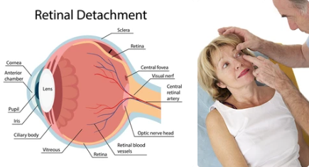 망막박리 수술 후 관리