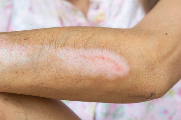 부산에서 화상 흉터제거 잘하는 병원과 효과적인 시술법!