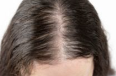탈모-예방-방법