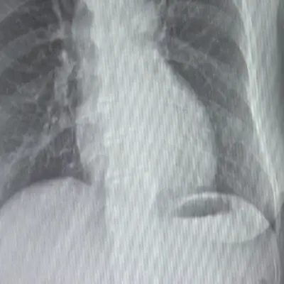 결핵-증상-원인-건강