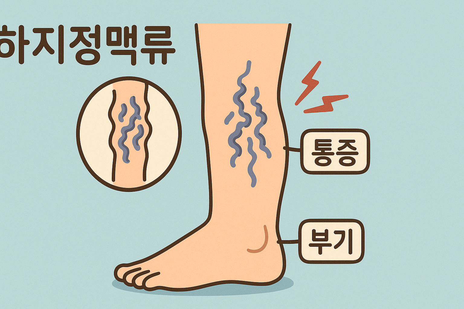하지정맥류에 관한 사진