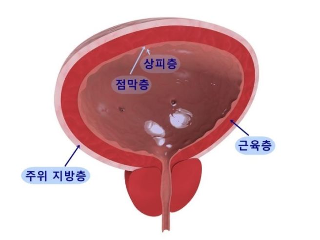 암보험 상피내암