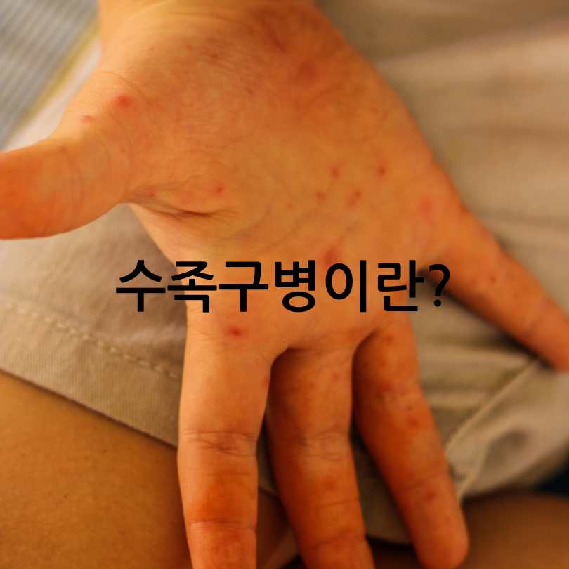 성인수족구 감염&amp;#44; 증상&amp;#44;원인&amp;#44; 경험담까지