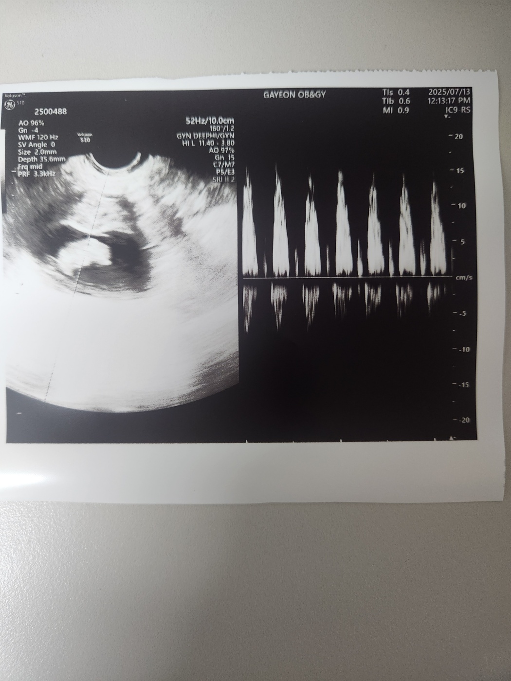 임신9주차, 9주1일차 초음파 젤리곰 난황