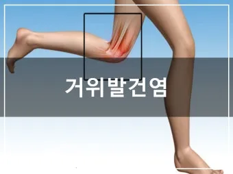 거위발 건염 원인과 증상 무릎 안쪽 통증 치료법 정리_15