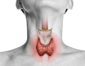 갑상선 기능 저하증 증상