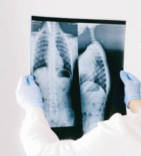 폐섬유화 증상과 원인, 초기 치료법은?