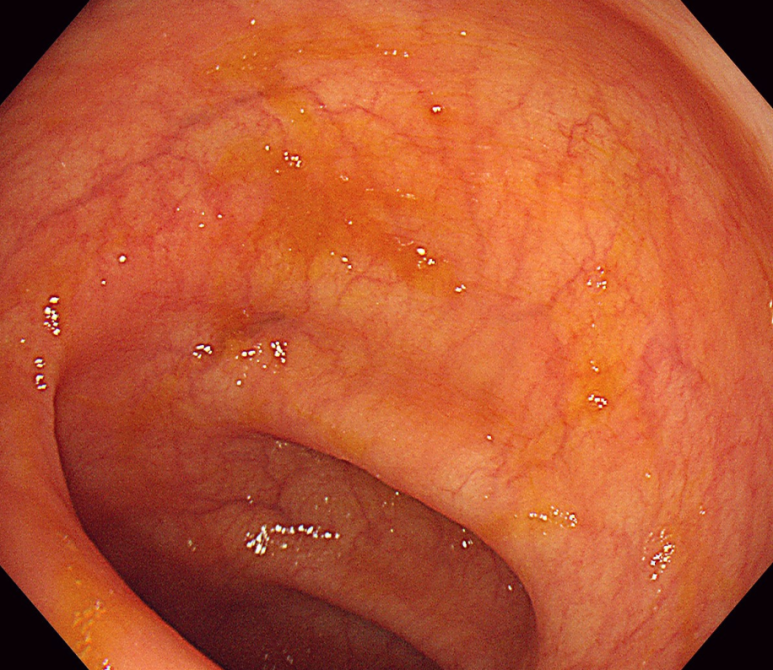 허혈성 대장염 사진