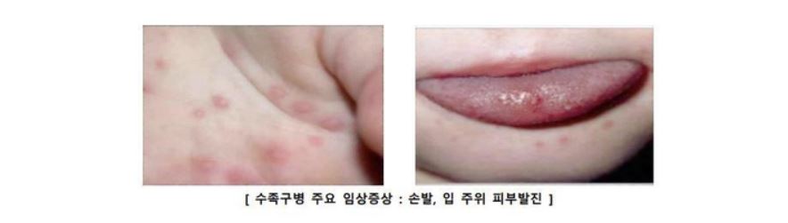요즘 유행하는 수족구병에 대한 모든 것 ❘ 증상, 잠복기, 전염기간, 예방법, 치료법