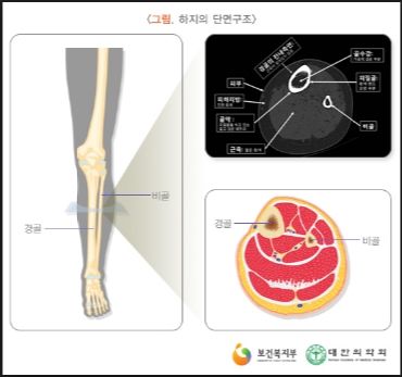 골수염 증상