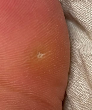 티눈 밴드 사용 후기 - 티눈