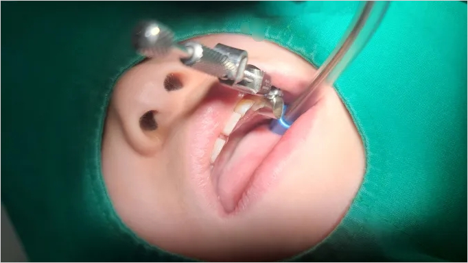 유치 충치 홈메우기