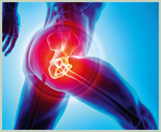 고관절 수술후 회복기간