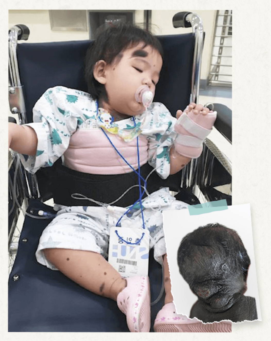 몸 절반 이상이 점으로 태어난 아이2