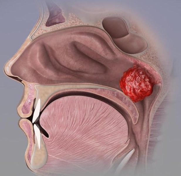 아데노이드 수술
