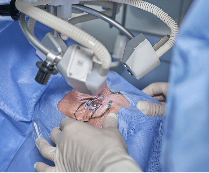 눈 레이저 수술