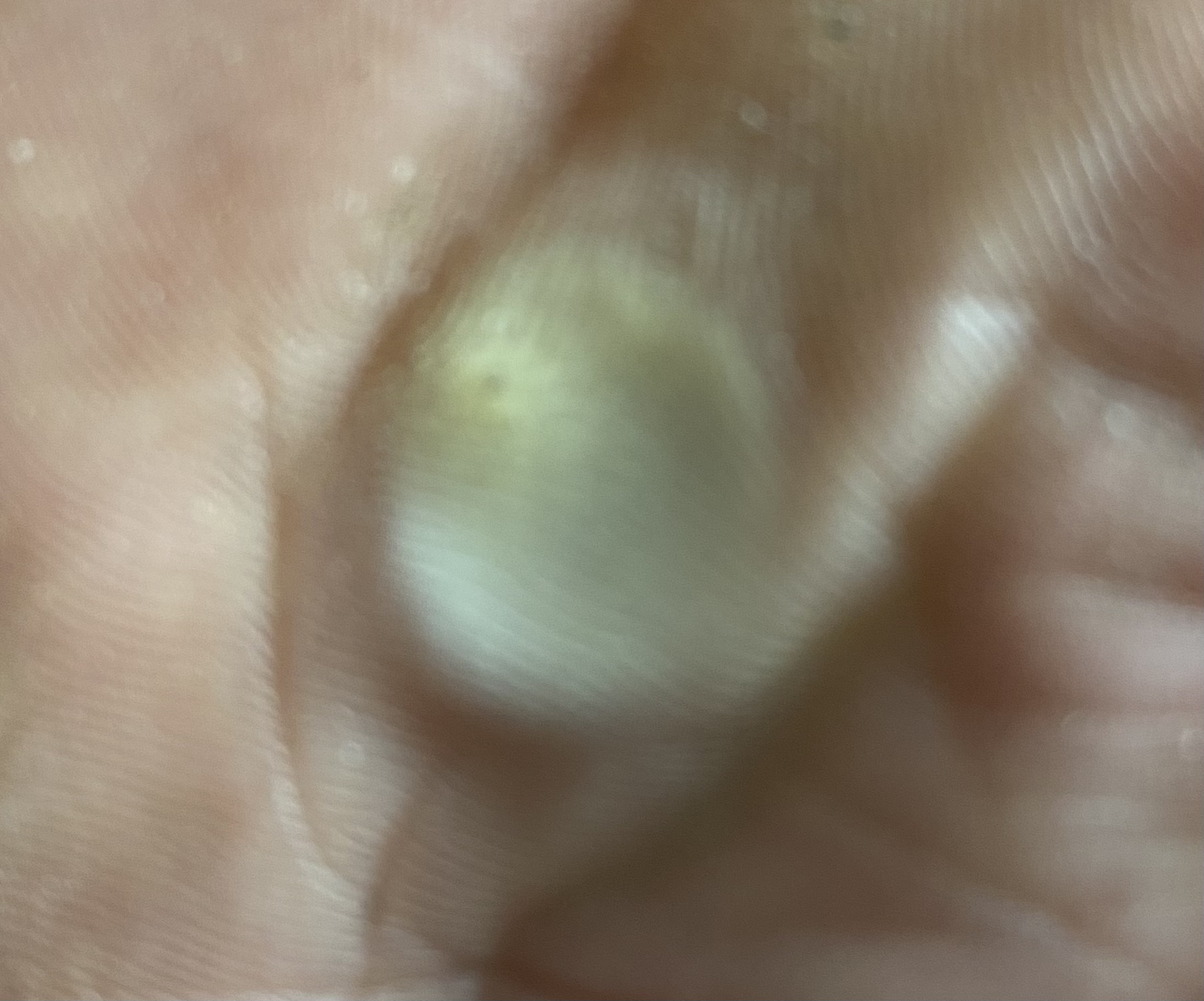 둘째날 티눈 박힌 부분이 점처럼 부어있죠.