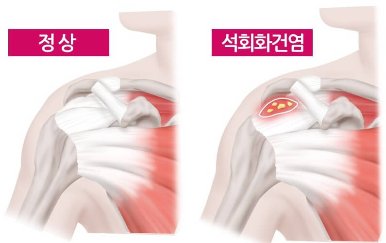 어깨 석회화건염 (3)