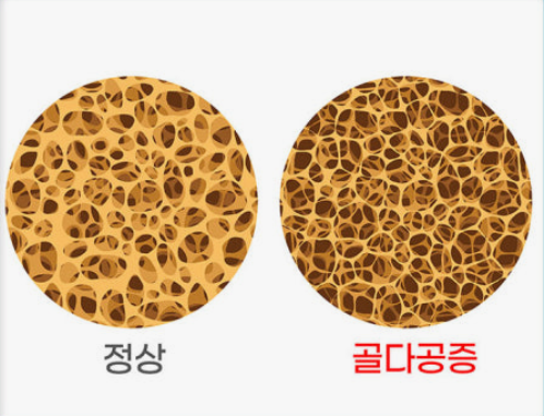 골밀도 검사 결과, 수치가 달라지는 이유와 치료 전 확인 핵심