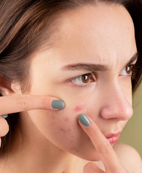 여드름이 생기는 이유, 여드름 치료 연고 알아보기