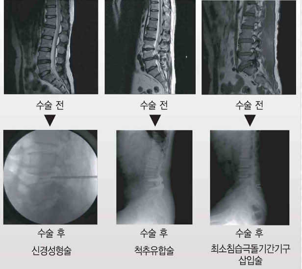 허리디스크 증상