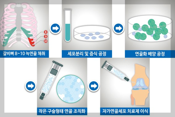 자가연골세포 이식술을 나타낸 그림