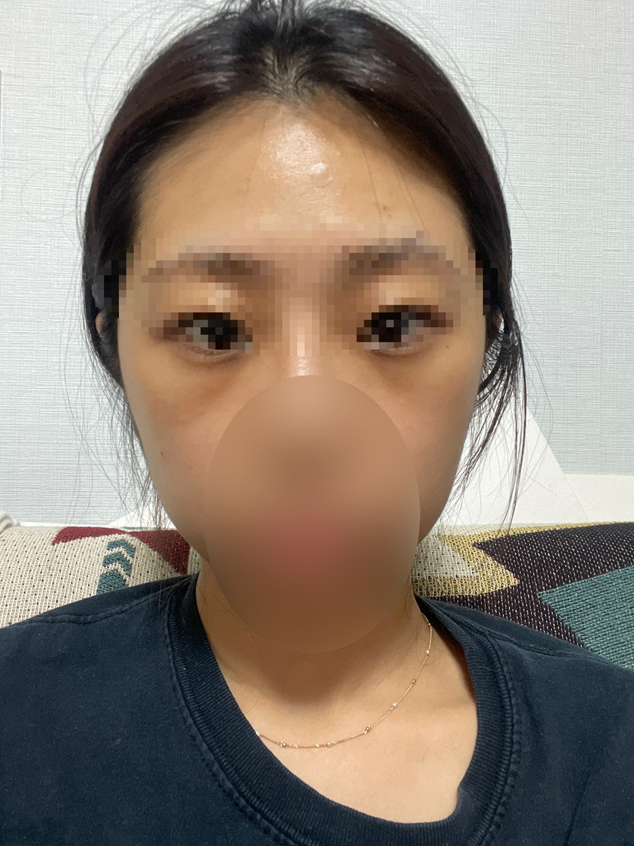 눈밑필러 시술