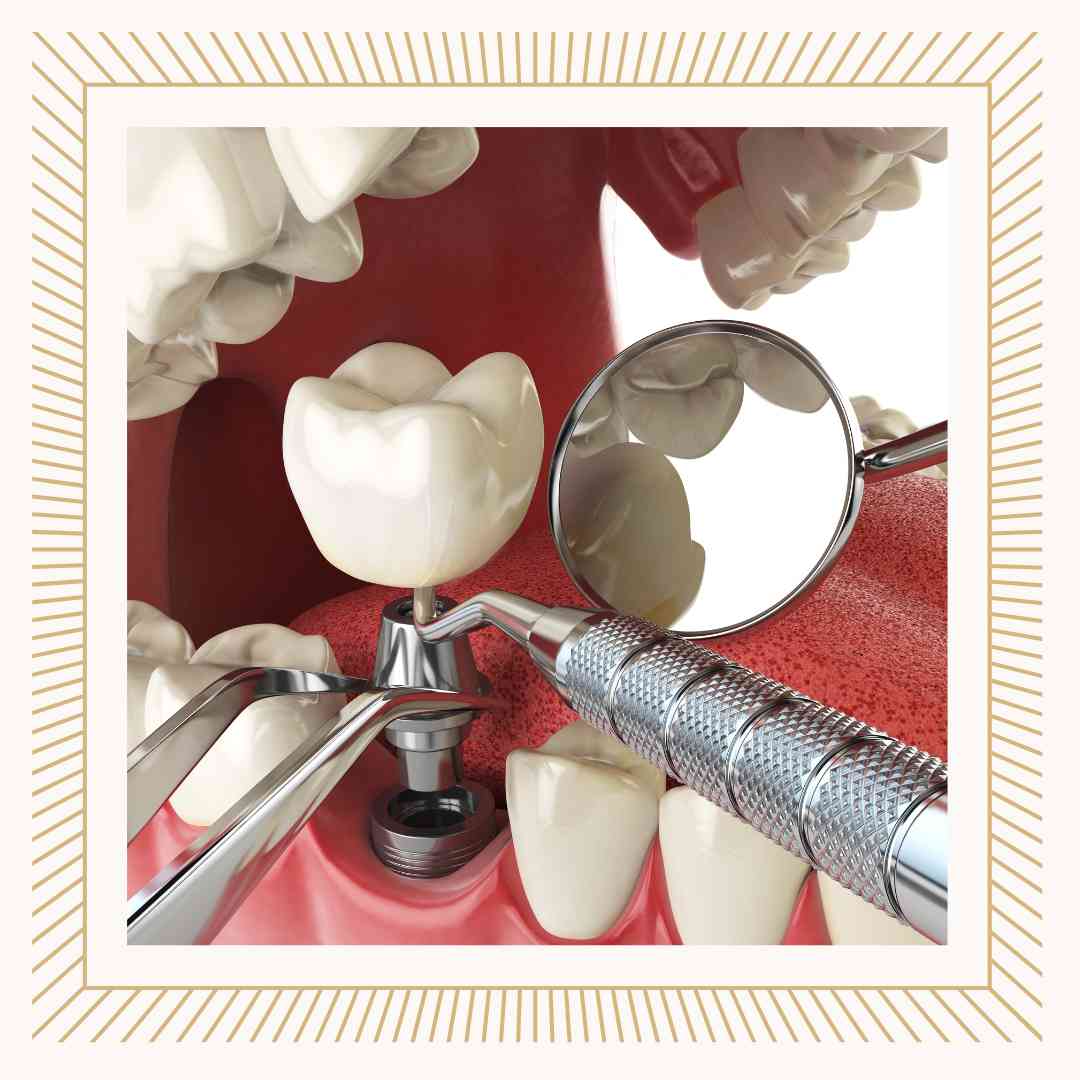 임플란트 건강보험