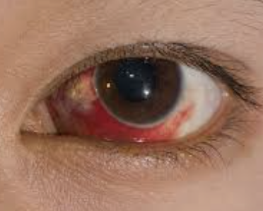 눈 핏줄 터짐 응급처치3