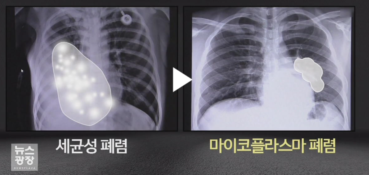 마이코플라즈마 폐렴