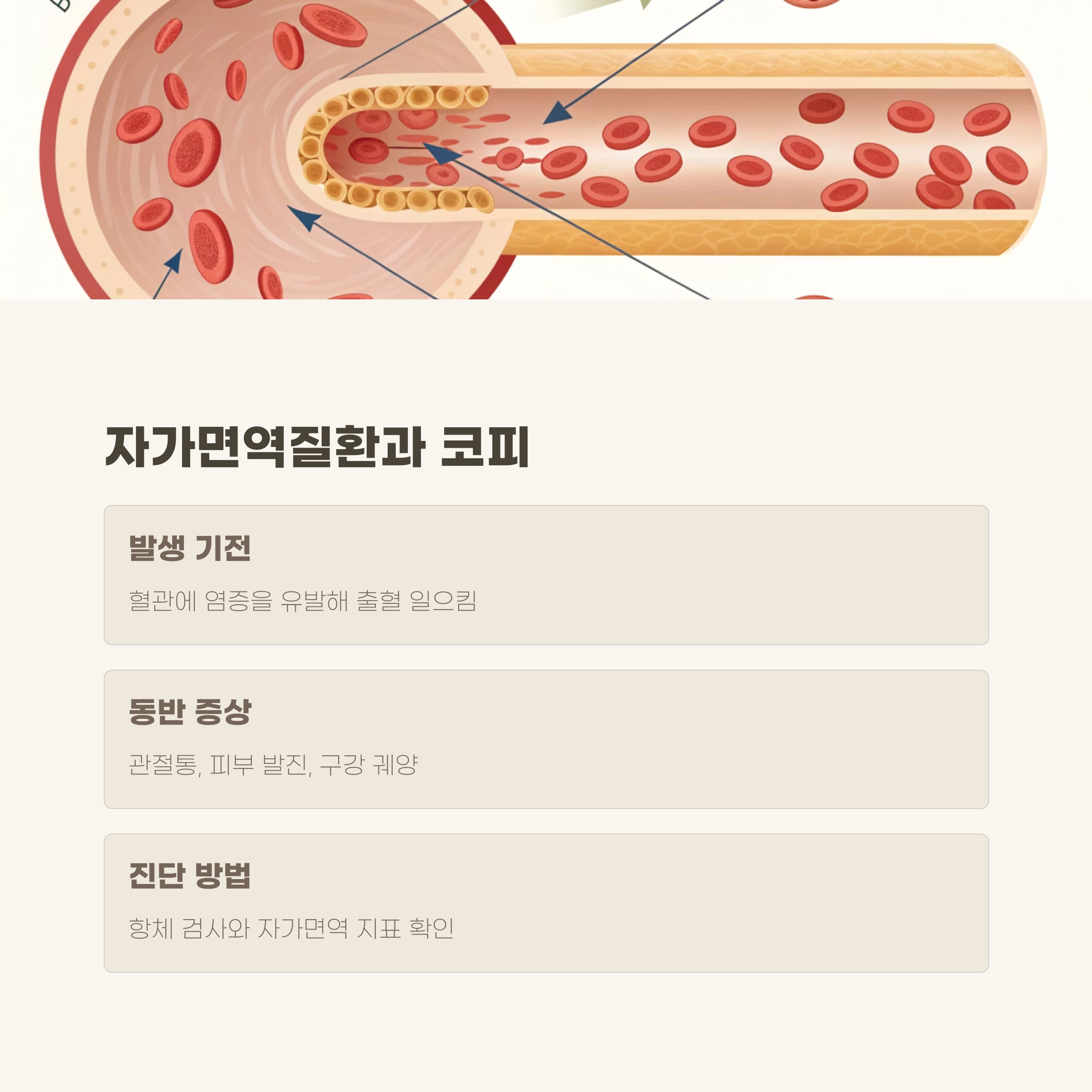 자가면역질환: SLE 등에서 점막 출혈 흔하게 나타난다
