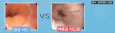 역류성 식도염 입냄새