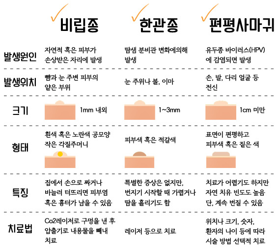 비립종 관련 이미지