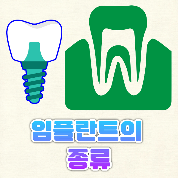 임플란트의 종류