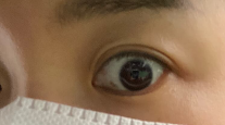결막모반 제거 후기