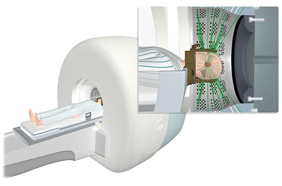 감마나이프(Gamma Knife)
