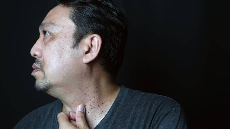 쥐젖 제거 비용 얼마나 들까? 시술별 가격 총정리!